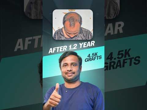 4500 Grafts Hair Transplant in Hyderabad | Cost & Results #hairtransplant #hyderabad #shorts
