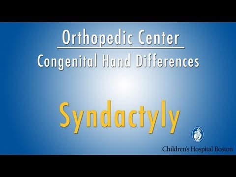 Video: Syndactyly - Klassificering, Orsaker, Behandling