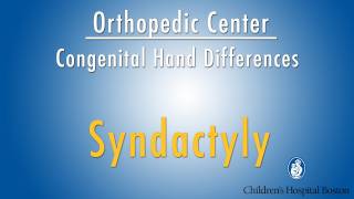 syndactyly - congenital hand differences - Boston Children's Hospital