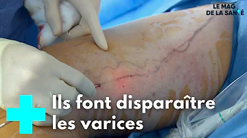 Comment on opère les varices ?