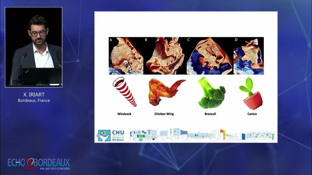 Une fermeture de l‘auricule gauche YouTube Une fermeture de l‘auricule gauche YouTube