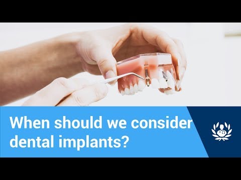 When should we consider dental implants?