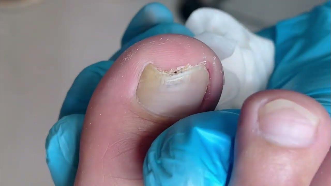 How to repair ingrown toenail YouTube