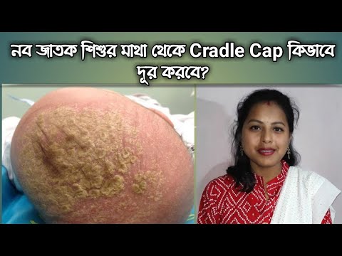 ভিডিও: শিশুদের খুশকির চিকিৎসা করার টি উপায়