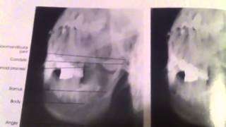 Skull trigger