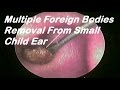 Multiple Foreign Bodies Removal From Small Child Ear