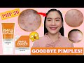 59PHP Pantanggal PIMPLES | Quick Fx Pimple Eraser