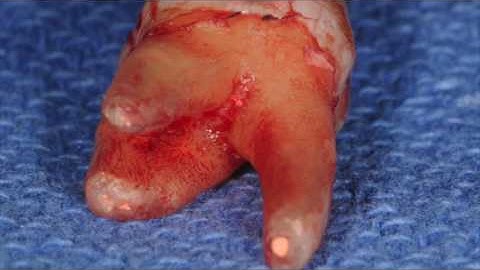 Management of Maxillary Sinus Perforation Following Tooth Extraction