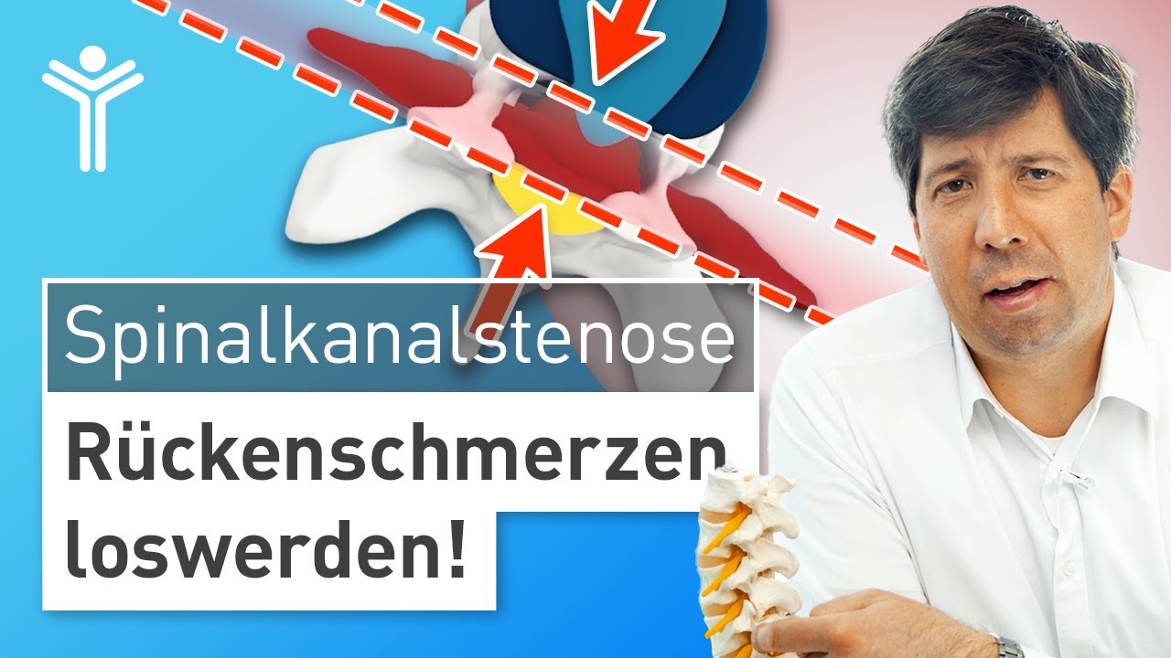 Wo Hat Man Schmerzen Bei Spinalkanalstenose