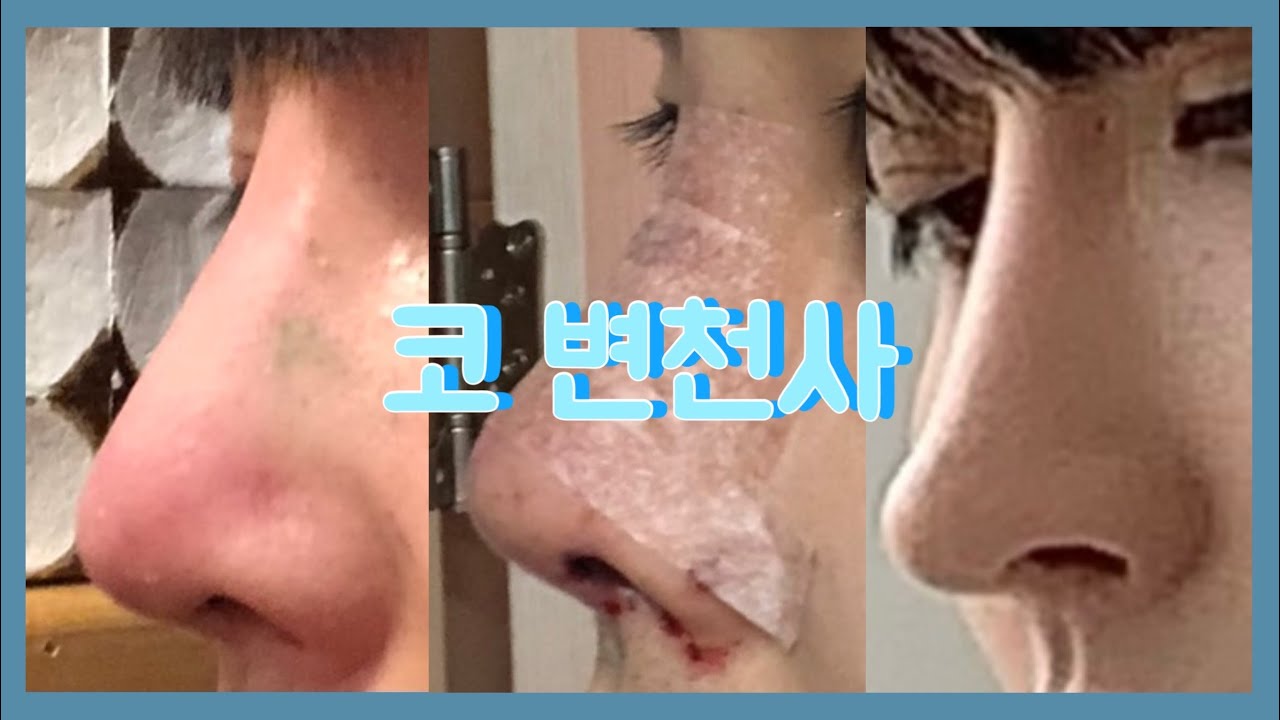 첫수술 부터 지금 까지의 코모양 변천사 공개함|코성형|코수술|코재수술 - YouTube 첫수술 부터 지금 까지의 코모양 변천사 공개함|코성형|코수술|코재수술 - Youtube