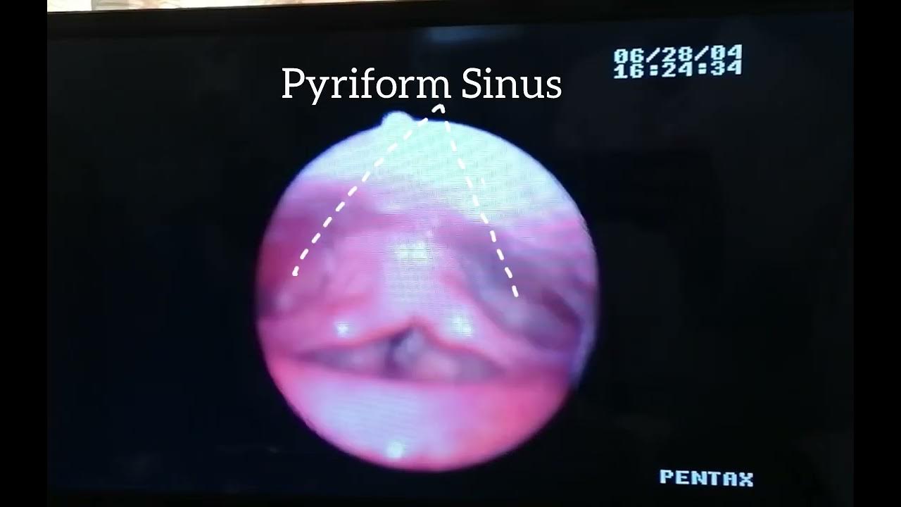 Nasopharyngolaryngoscopy (NPL) showing Vocal cord polyp and Reinke’s