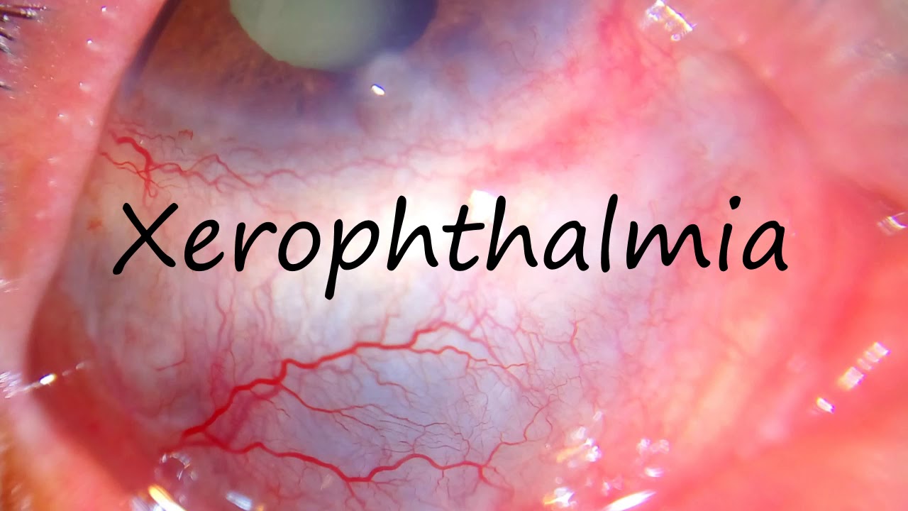 How to Pronounce Xerophthalmia?