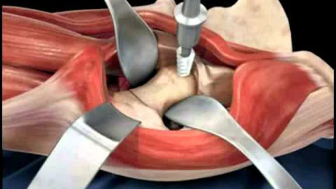 Hip replacement surgery techniques - Dr. Scott Dev...