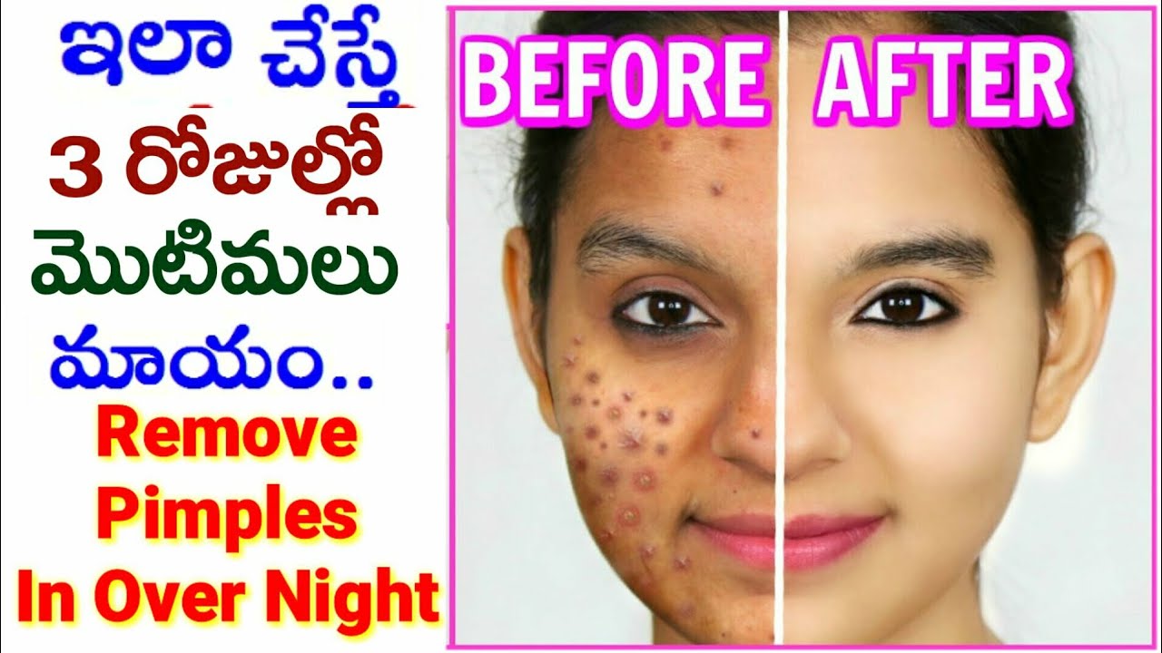 How To Remove Pimples In overnight In Telugu / Telugu Beauty Tips / Get Rid of Pimples In telugu