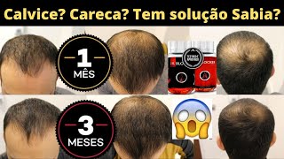 Estou ficando careca o que fazer - Remédio para CARECA.