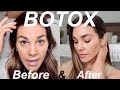 MY BOTOX EXPERIENCE | Before &amp; After | Pricing, Units, Results
