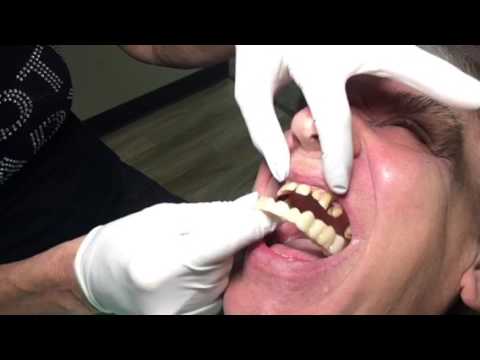 Houston Cosmetic Dentist: Snap-on Smile and Men..chipped, gaps, yellow teeth