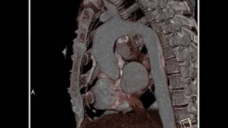 Cardiac: Coronary artery bypass grafts (1 of 3)