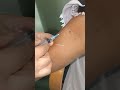 Effortless Vein Detection for Accurate Blood Sampling