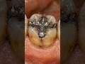 The Exact Way Dentists Restore Damaged Teeth #dentistry #satisfying