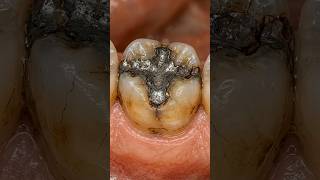 The Exact Way Dentists Restore Damaged Teeth #dentistry #satisfying
