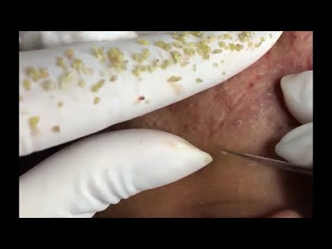 Acne extractions|Blackheads,Whiteheads, Pimples And Cystic Acne Extraction Facial Treatment