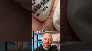 Doctor reacts to amazing cyst pops! #useretinol #dermreacts #doctorreacts