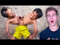 Reacting To The World's Most Insane Conjoined Twins (Miracle!)