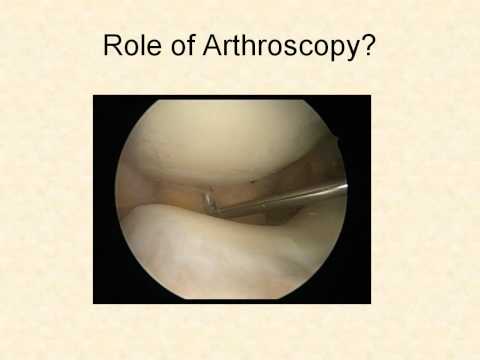 5-Keating-sicotpatella2011.avi