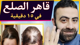 اكتشفت علاج ينبت الشعر في ١٥ دقيقة في يوم و يعالج الصلع هاجربه معاكم عملي في الڤيديو