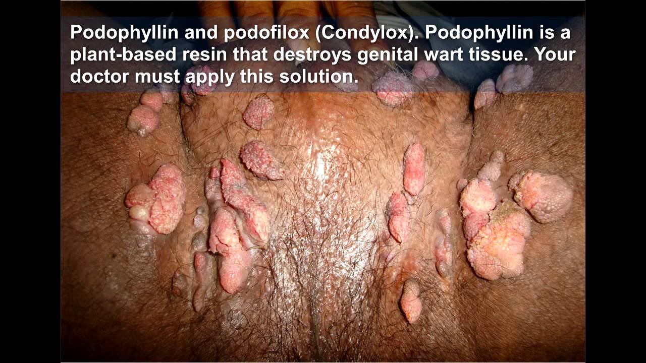 Genital warts: MedlinePlus Medical Encyclopedia