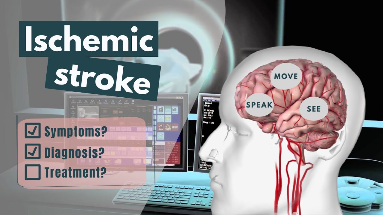 ⁣Ischemic Stroke Animation | Symptoms, diagnosis, treatment & prognosis