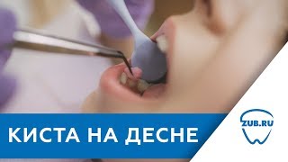 Киста на десне