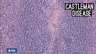 Malattia di Castleman