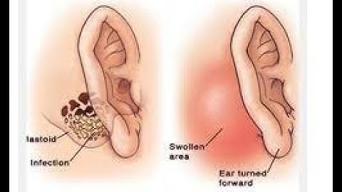 Mastoidectomy CPT code - simplify medical coding
