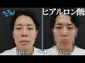 【ヒアルロン酸注射】M-1に向けてネタの前に顔を調整する?【令和ロマン】