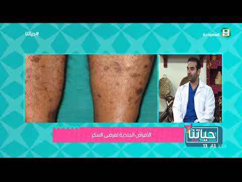 فيديو: ما الذي يسبب ظهور بثور على القدمين؟