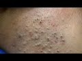 ASMR Korean Skincare Routine For Blackhead Removal And Facial Deep Cleansing