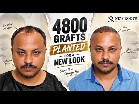 4800 Grafts Hair Transplant Transformation |Hair Transplant Cost in Siliguri