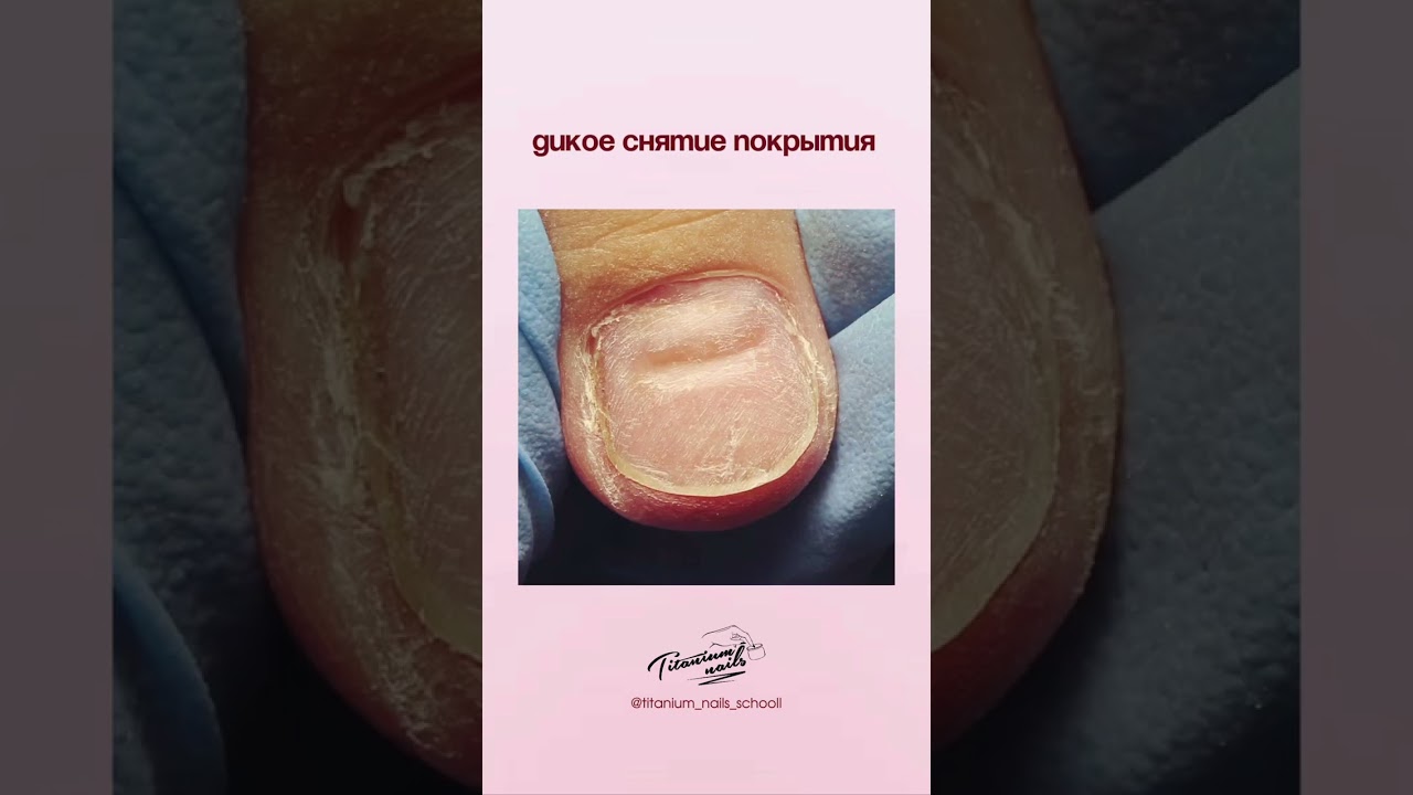 Титановые ногти / не акрил / покрытие для аллергиков