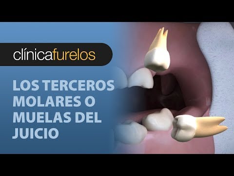 Vídeo: ¿Por Qué Tenemos Muelas Del Juicio: Qué Son, Cómo Crecen Y Más?