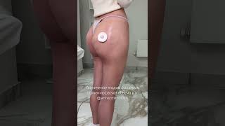 Ягодицы филлером ,увеличение коррекция #обучениекосметологов #ягодицы