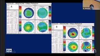 Details Dr Shreyas Ramamurthy - Combining Tomography & Biomechanics - 1st India Pentacam User Meeting News