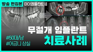 디지털 기술을 활용한 무절개 임플란트 치료사례  |  50대/남 어금니 상실