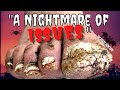 A Nightmare of Issues: Trimming Fungal Toenails and A Surprise on the Big Toe (Halloween Special)
