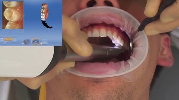 ESCANEO CEREC AC OMNICAM 1 0