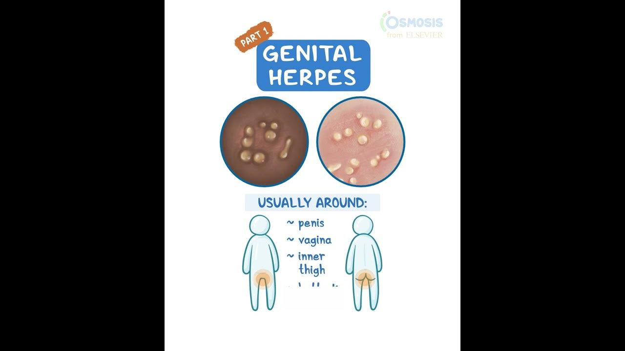 Explain Various Stages Of Genital Herpes