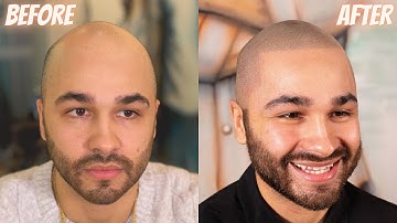 VERY IMPRESSIVE Scalp Micropigmentation Result with Matt Iulo