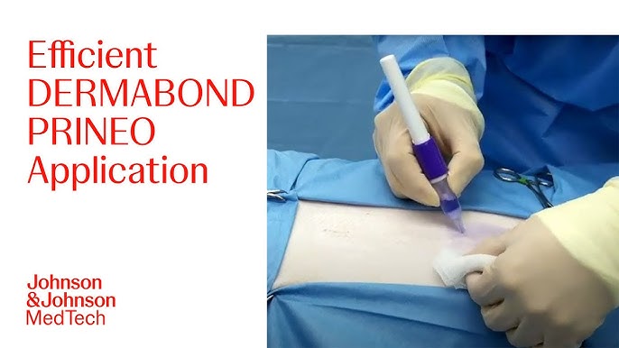 Step-by-Step Guide for Effective Application of DERMABOND PRINEO