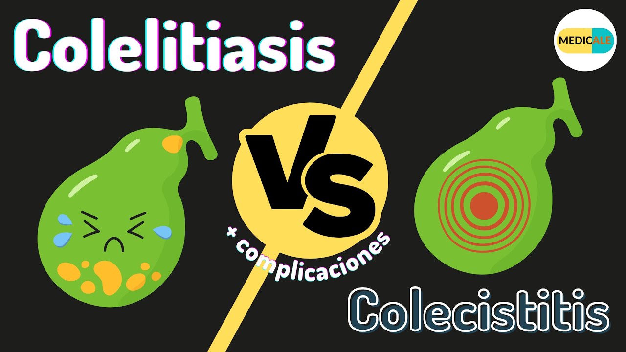 Colelitiasis y colecistitis - CUADRO COMPARATIVO Y COMPLICACIONES - ViDoe